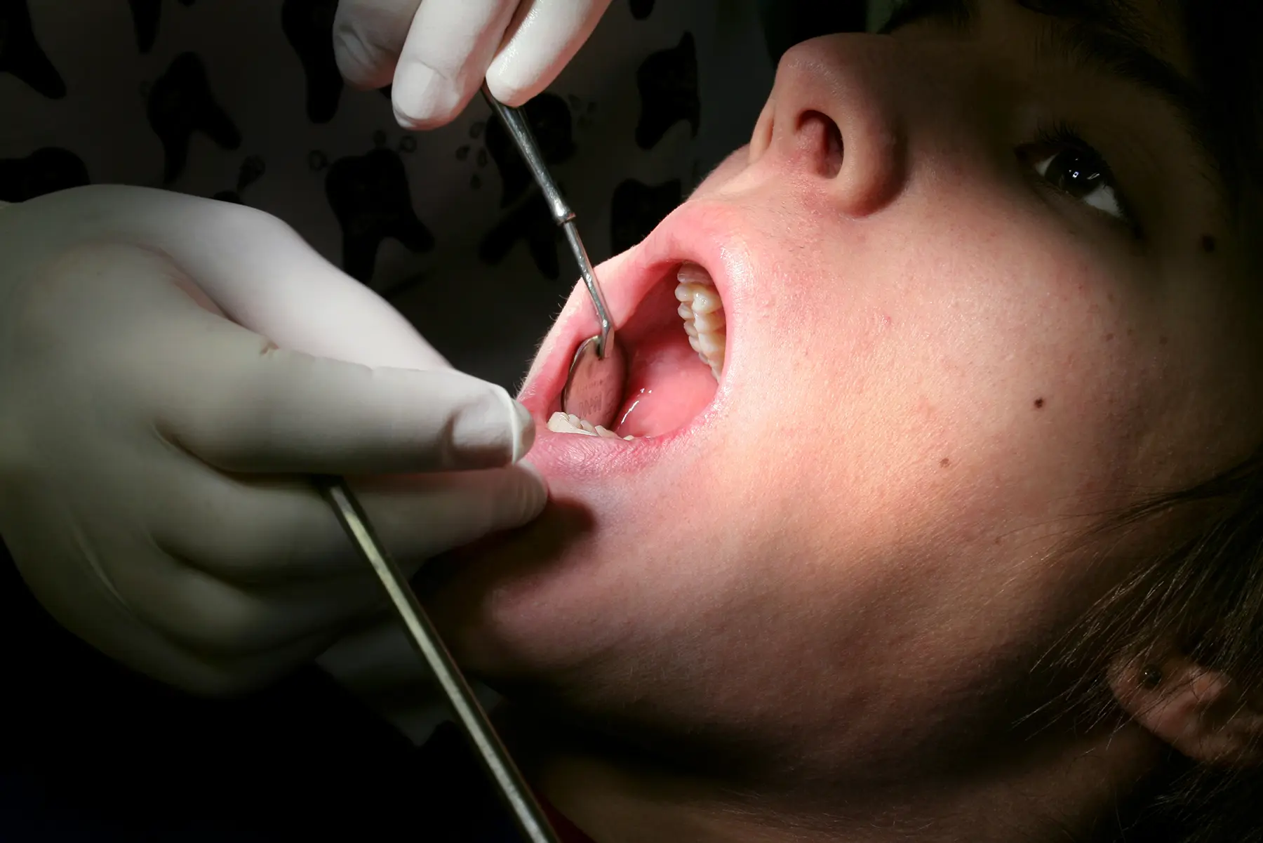 Linea Alba in the Mouth: What It Means and How It Differs from Leukoplakia