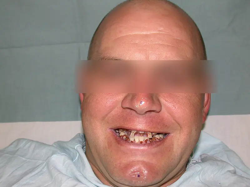 Before treatment photo of a patient with multiple severely damaged, decayed, and missing teeth prior to full-arch dental implant restoration.
