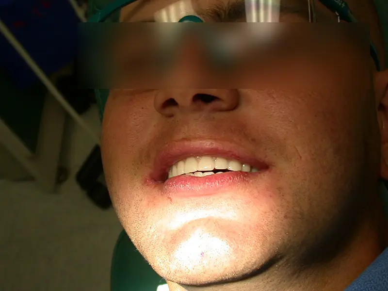 One week post-op follow up of a make patient with full arch dental implants.