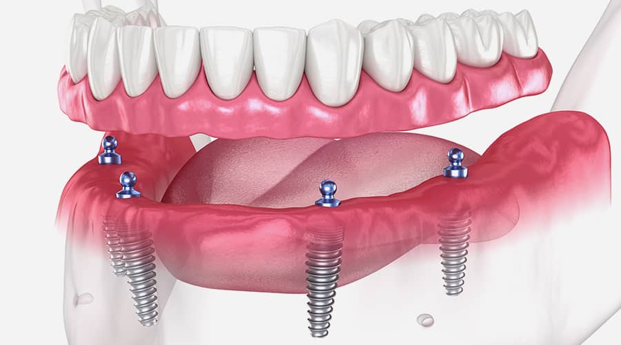 All-on-4 Dental Implants