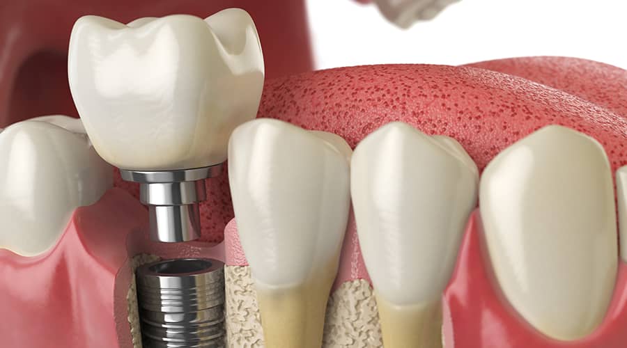 Dental Implants