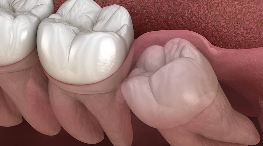 Impacted Wisdom Teeth