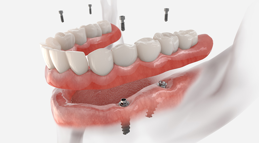 Implant-Supported Dentures