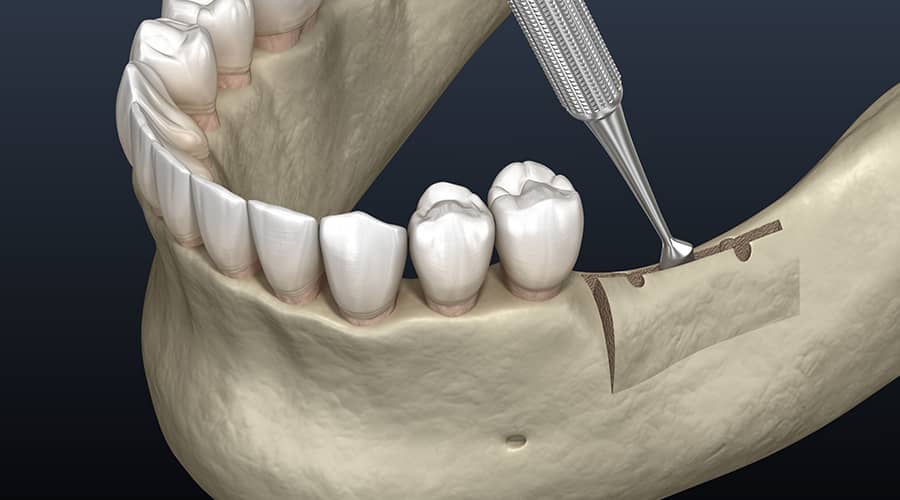 Ridge Augmentation