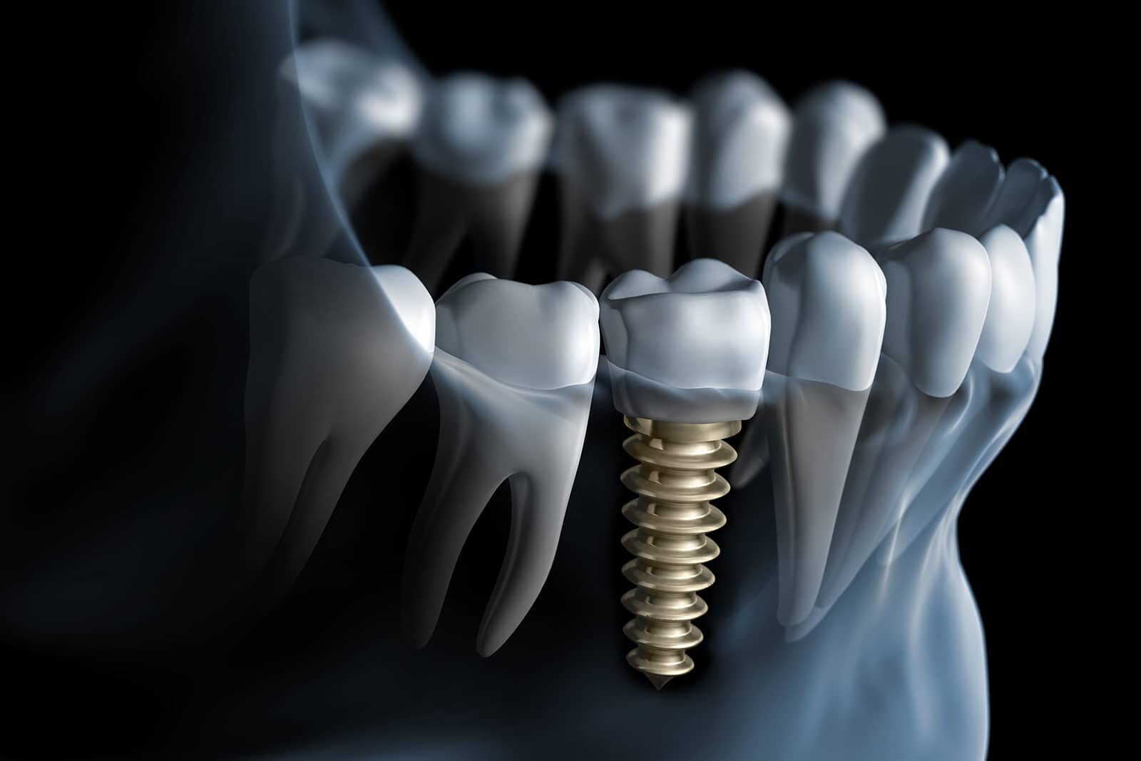 Are Dental Implants Worth the Cost?