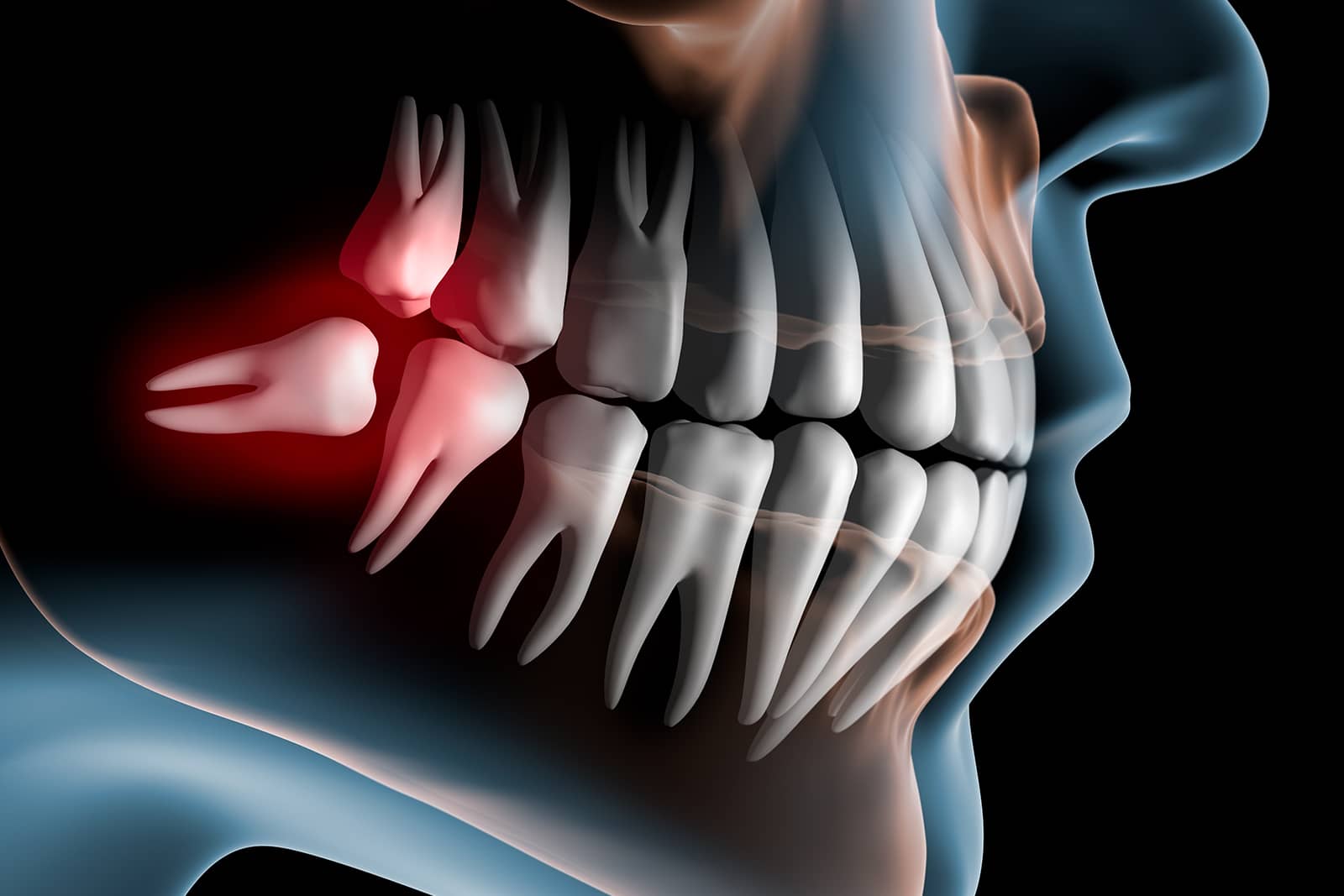 Why See an Oral Surgeon for Third Molar Extraction?